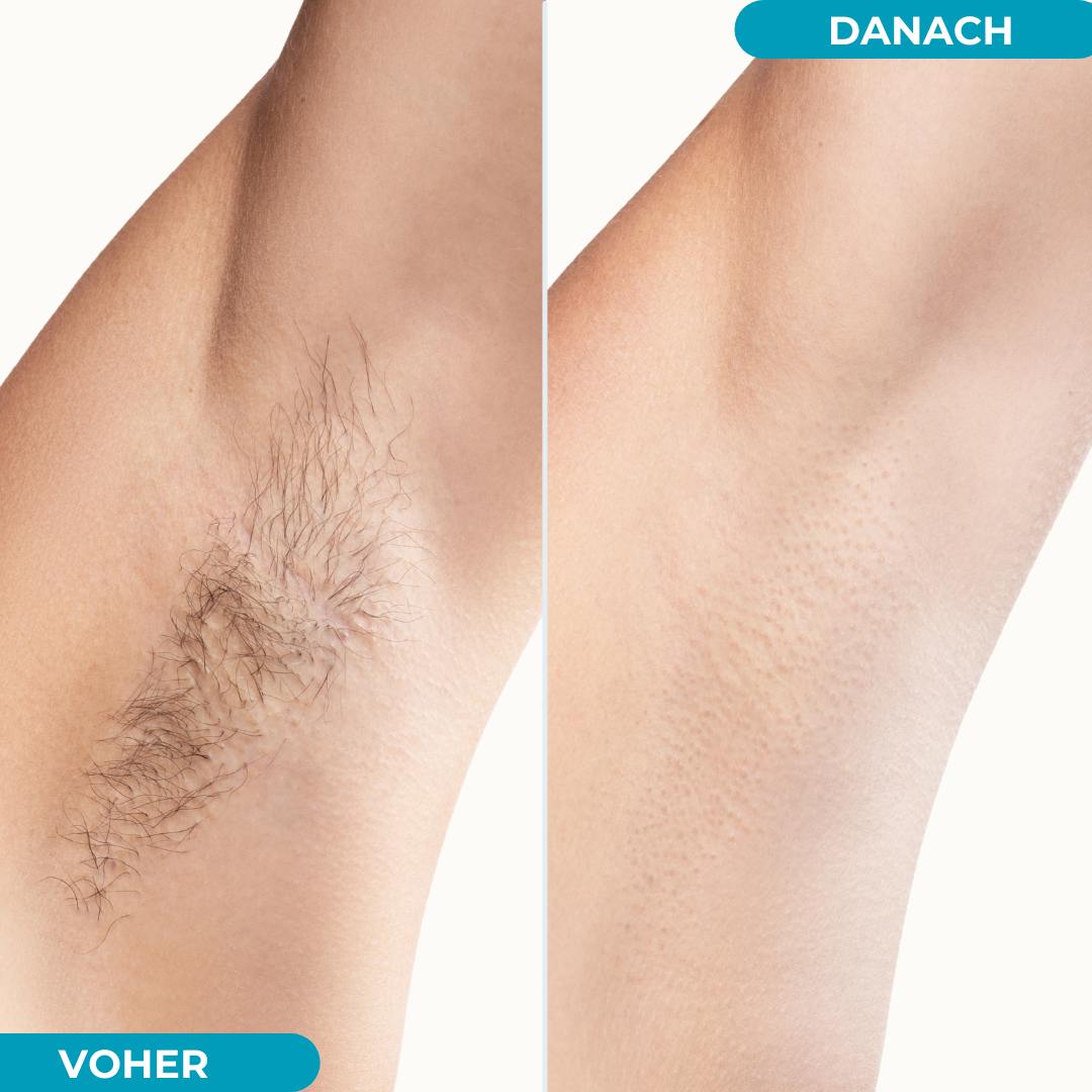 Hair Reduction Lotion